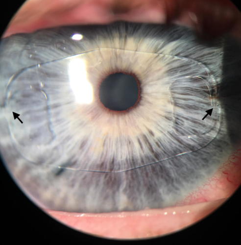 Artificial intraocular lens in the anterior chamber - iris claw design - phakic